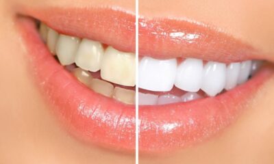 Keeping Your Smile Bright: Everyday Habits for Optimal Dental Health
