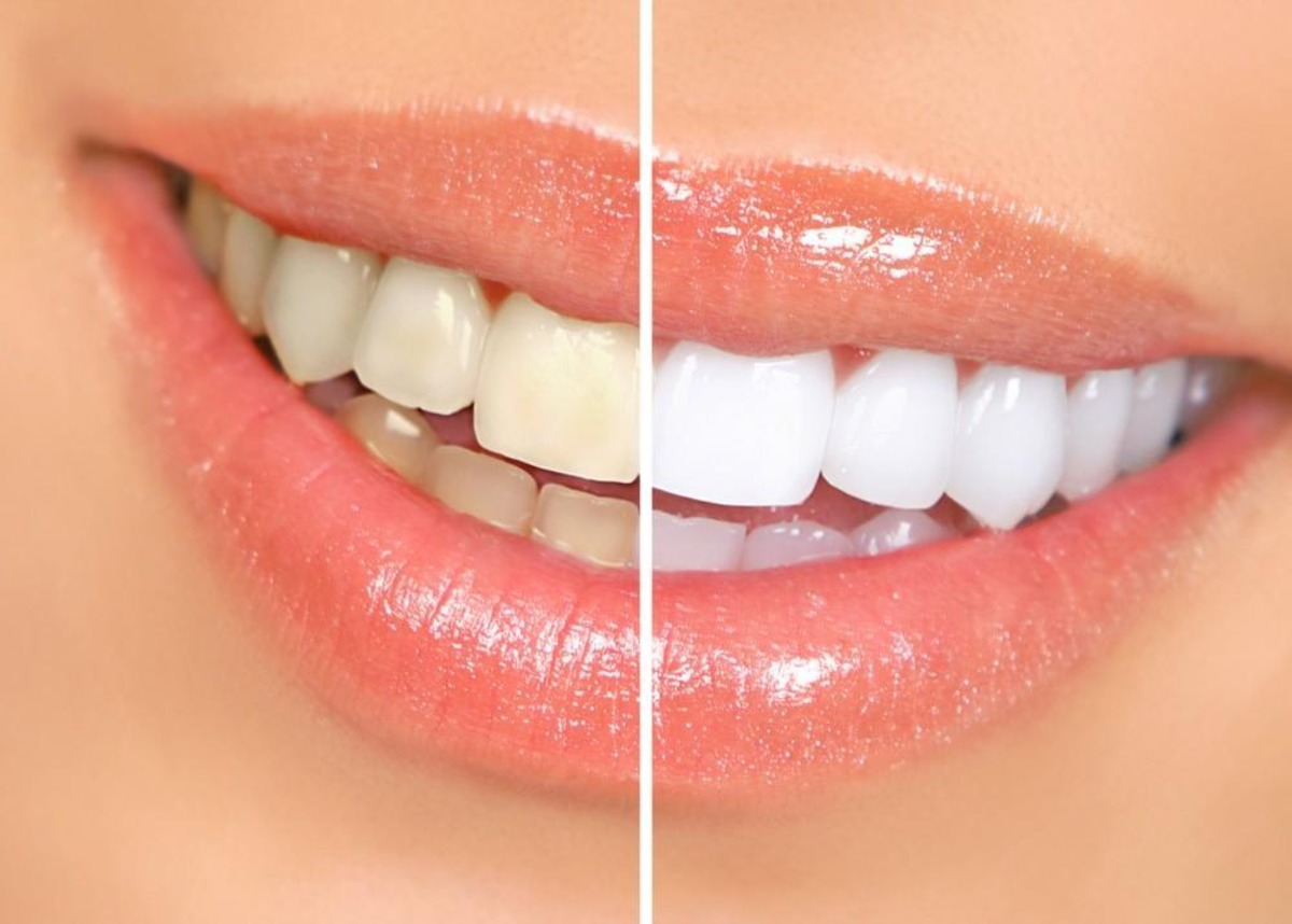 Keeping Your Smile Bright: Everyday Habits for Optimal Dental Health