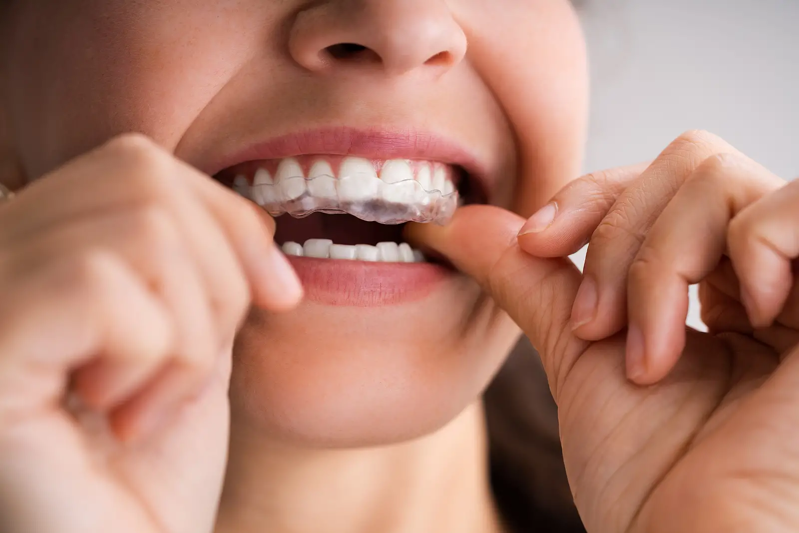 Common Pediatric Dental Issues and How Invisalign Can Help