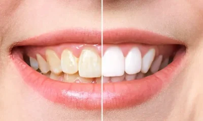 Brighter, Faster Safer: The Advantages of Modern Teeth Whitening Techniques