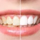 Brighter, Faster Safer: The Advantages of Modern Teeth Whitening Techniques