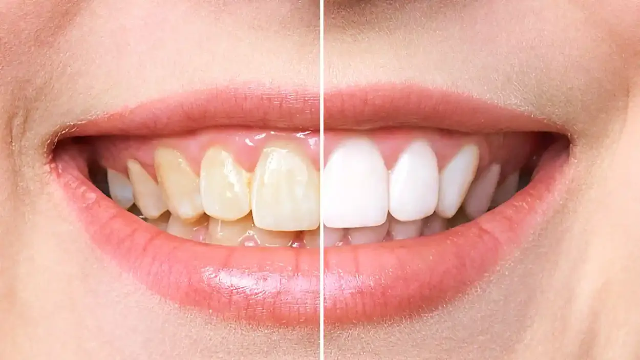 Brighter, Faster Safer: The Advantages of Modern Teeth Whitening Techniques